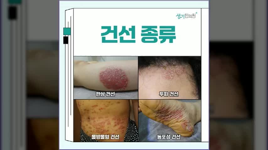 대연동 두피건선, 비듬이 심해진 것과는 조금 다릅니다