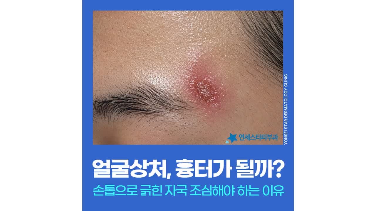 [신촌 연세스타피부과] 손톱흉터·얼굴긁힌흉터, 상태에 맞는 레이저 치료의 중요성