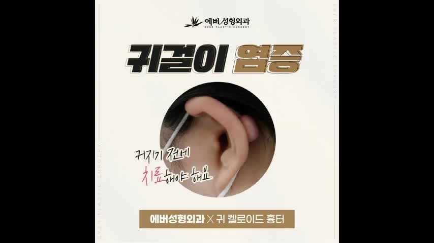 피어싱 귀 켈로이드 제거 수술 재발없는 치료 방식은?
