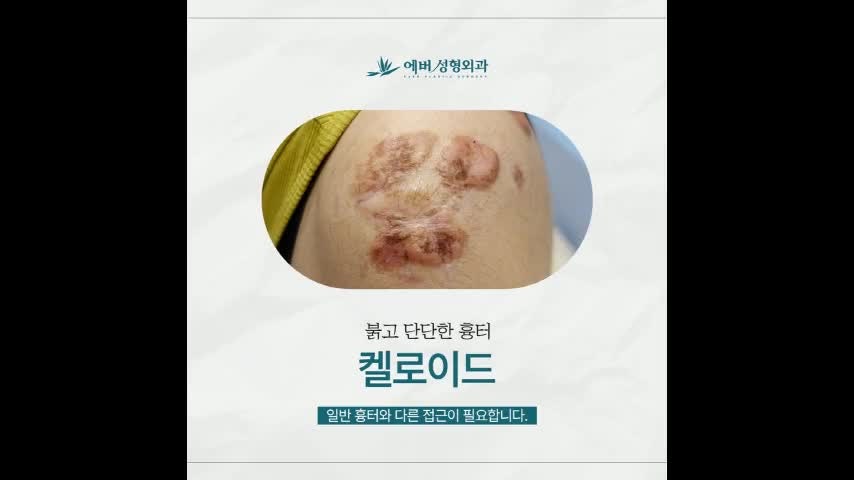 켈로이드 주사 통증 때문에 미루고 있었다면?