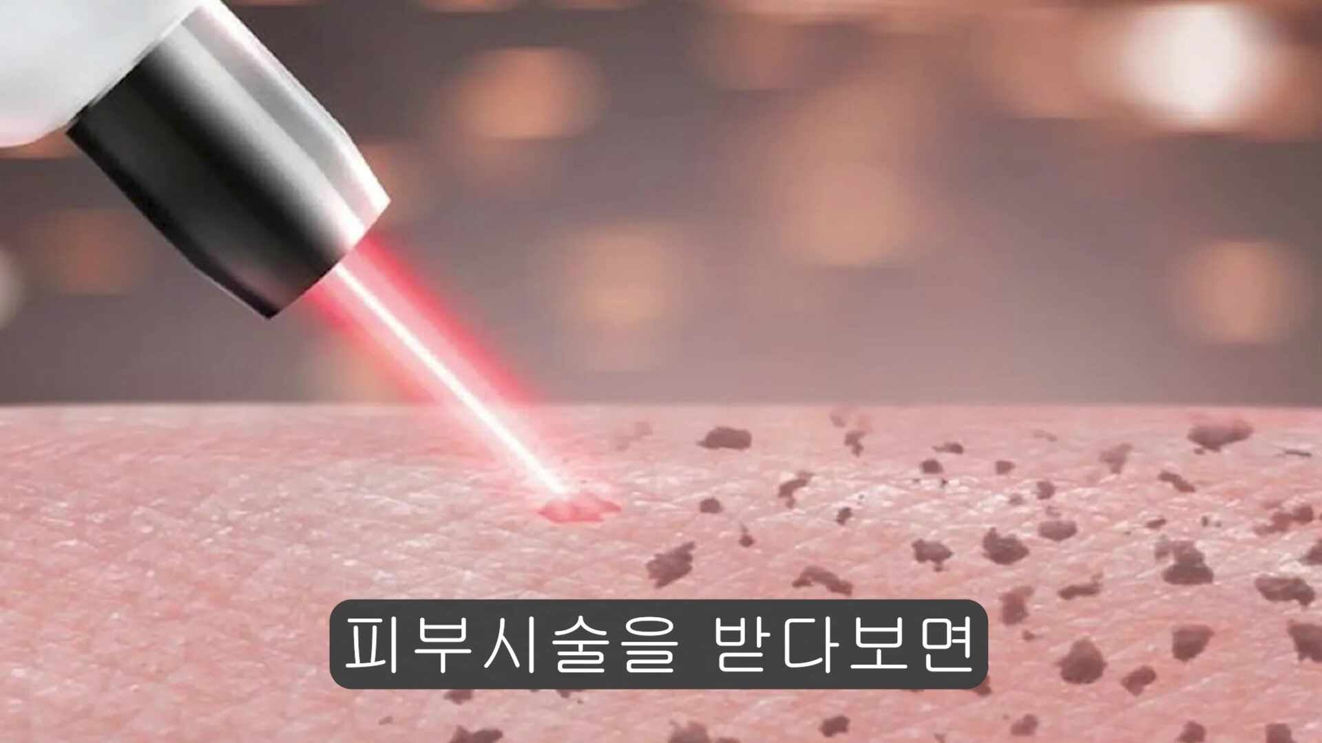 피부시술 후 흉터가 쉽게 남는 켈로이드피부체질의 확인방법(feat.신월동한의원)