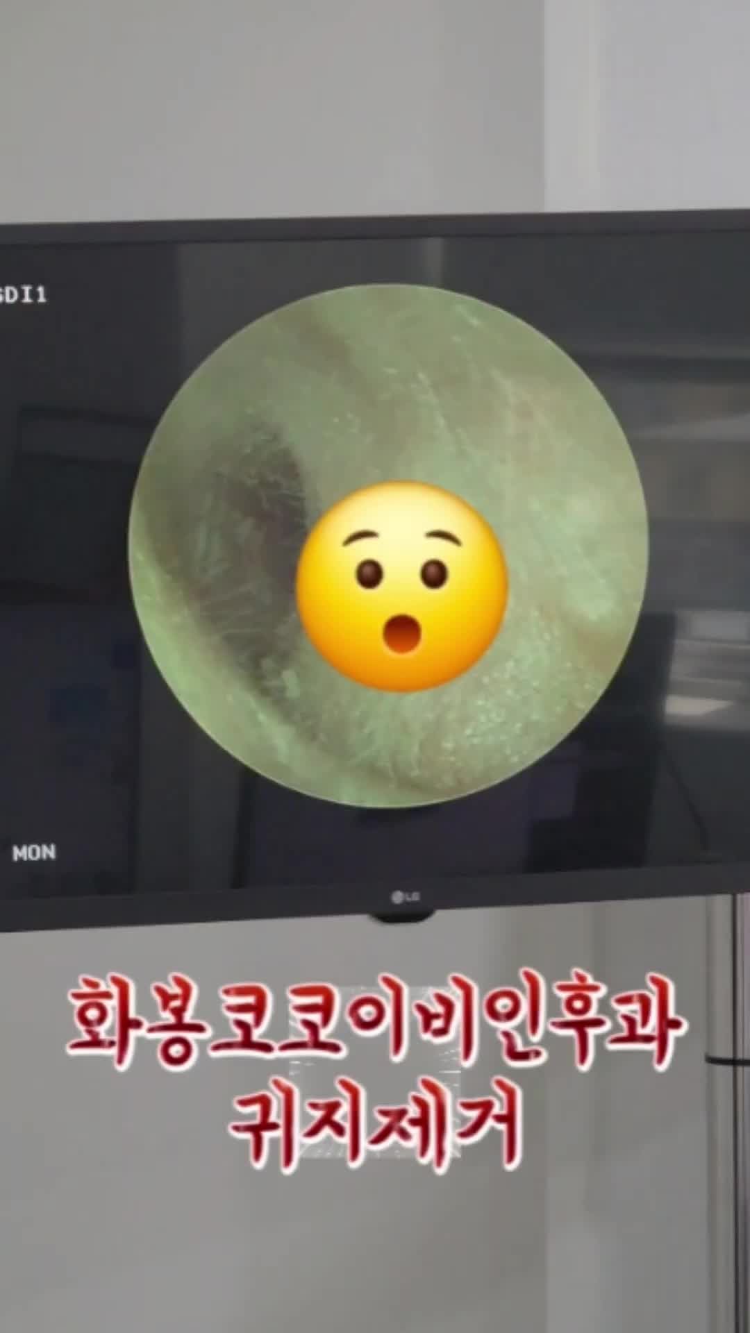 [울산 북구 화봉코코이비인후과] 귀지, 면봉으로 파내지 마세요! 원장이 직접 보여주는 안전....