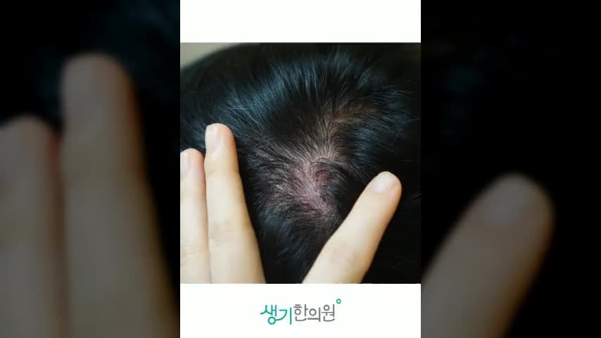 해운대 두피백선증, 단순한 비듬으로 생각하고 넘기면 안 되는 이유