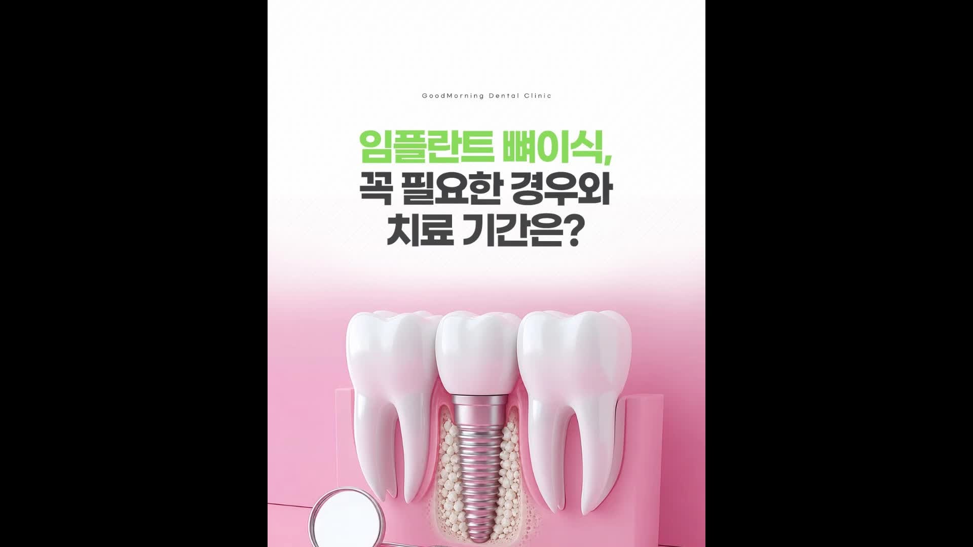 부산양정 임플란트 전 뼈이식 꼭 필요할까요?