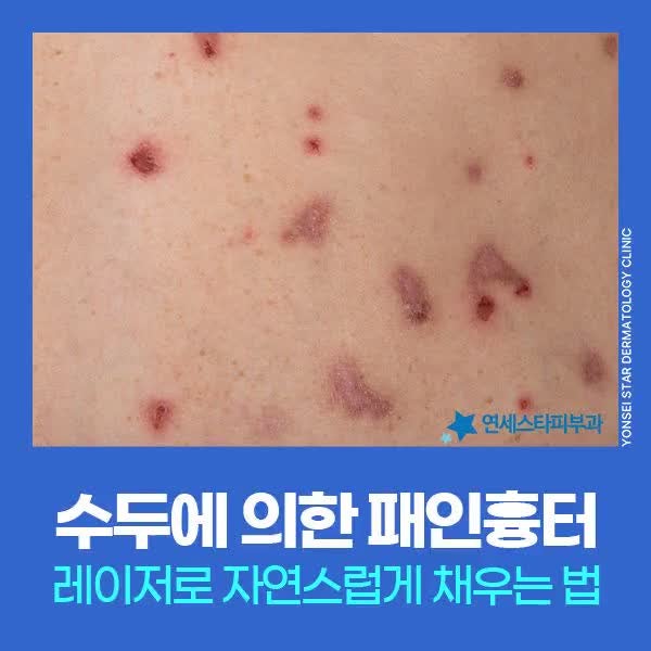 신촌 오래된 수두패인흉터 포기안해도 되는 이유, 레이저 복합 치료 주목