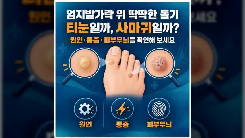엄지발가락 위 딱딱한 돌기, 티눈일까 사마귀일까? 피부과 비용까지 정리