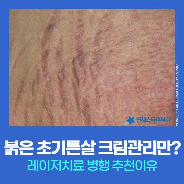 [신촌 연세스타피부과] 튼살크림 만으로 충분할까 붉은 초기튼살 없애는법 추천 레이저 효과....