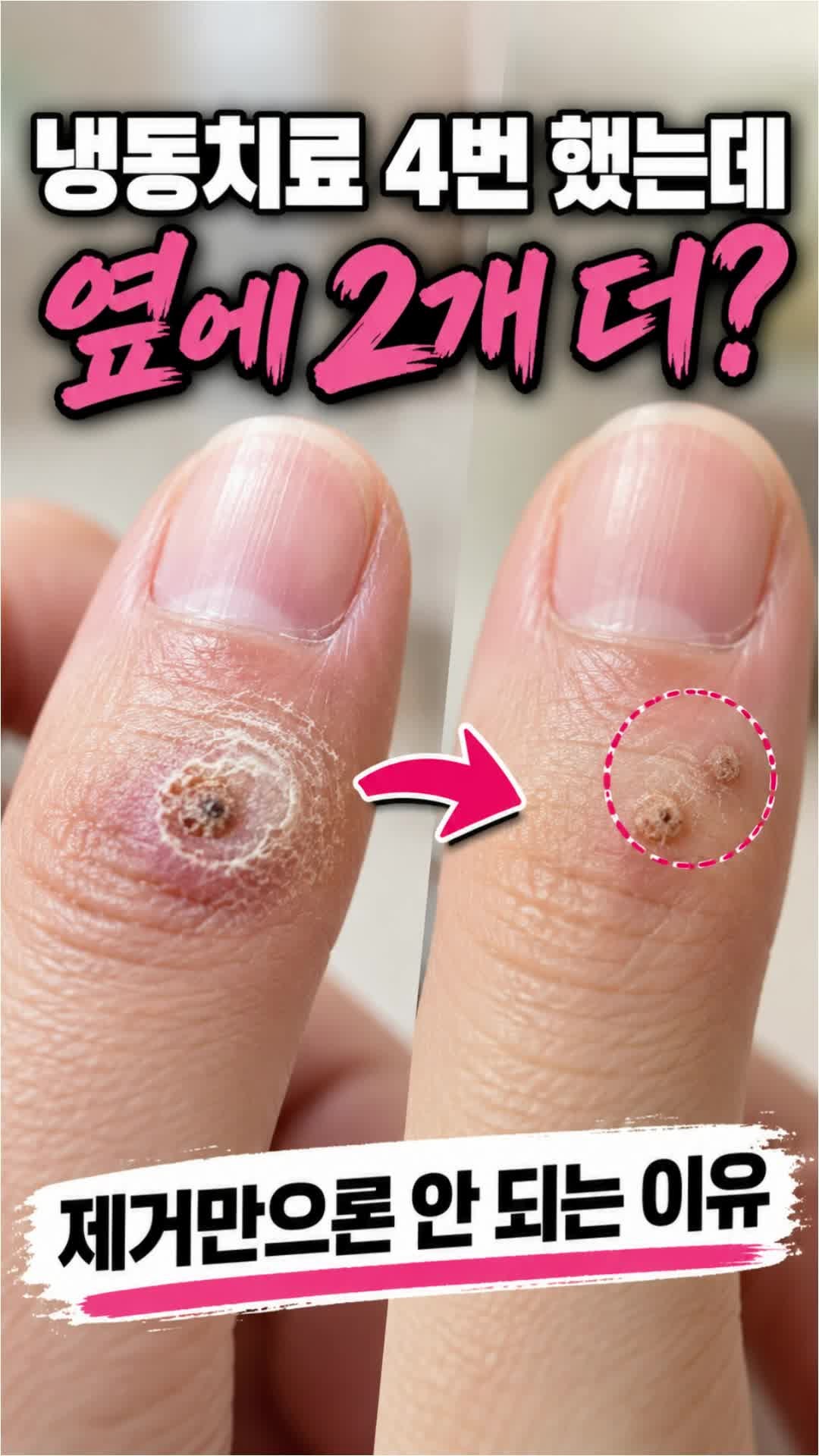 부천 사마귀 한의원, 냉동치료 후 옆에 더 생기는 이유