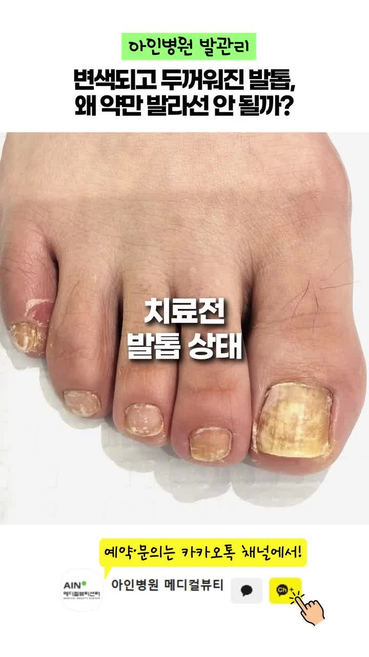 발톱무좀 실비 조건, 어떤 치료가 적용될까요?