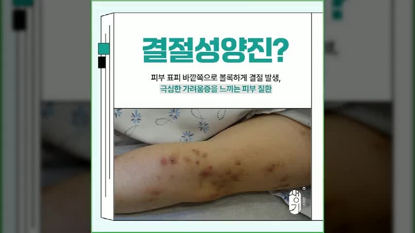 해운대 결절성 양진, 단순히 가려운 피부염이라고 생각해 방치하면 안 되는 이유