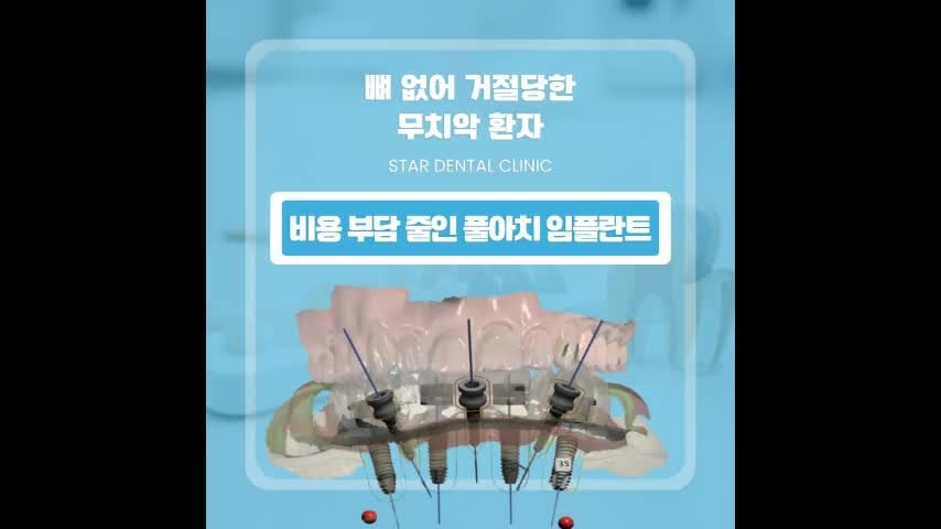 부산서구풀아치임플란트 전체임플란트 비용이 부담되거나 틀니불편함 느낄 때