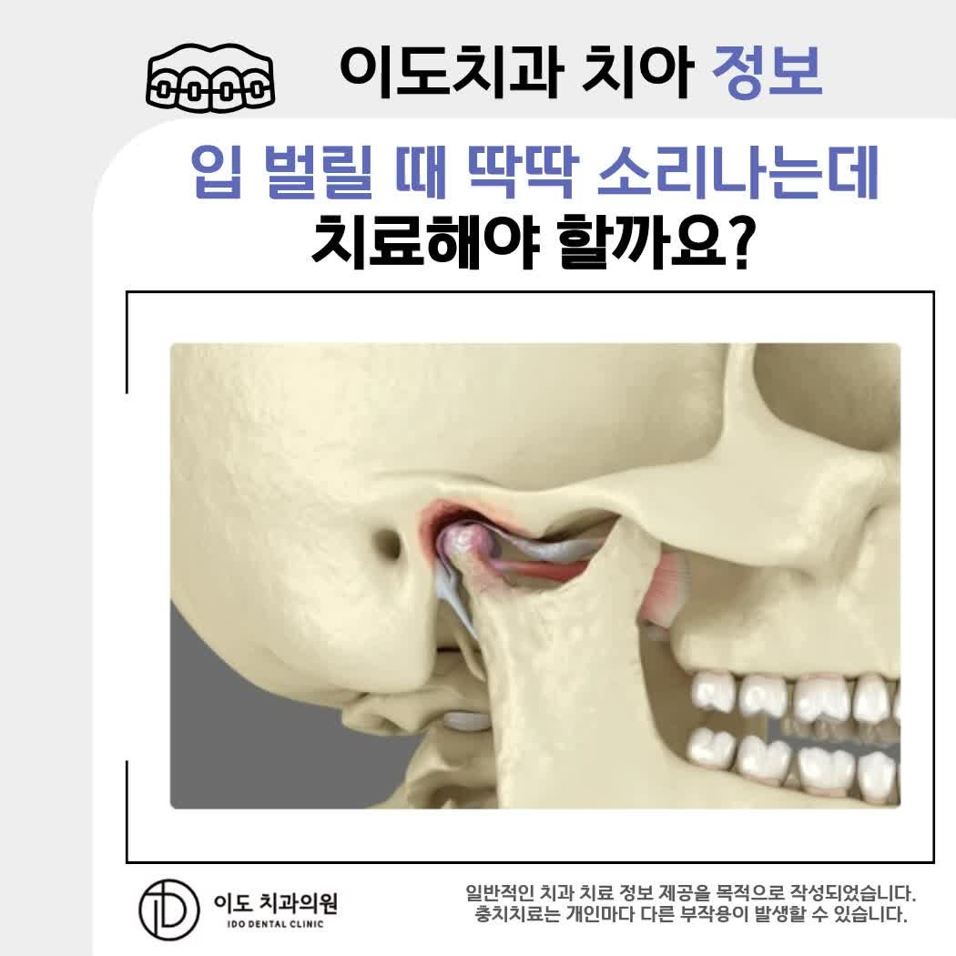 세종 턱관절, 입 벌릴 때 딱딱 소리가 나는데 치료해야 하나요?
