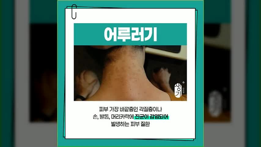 부산 어루러기, 땀을 많이 흘린 뒤 몸에 얼룩이 생겼다면?