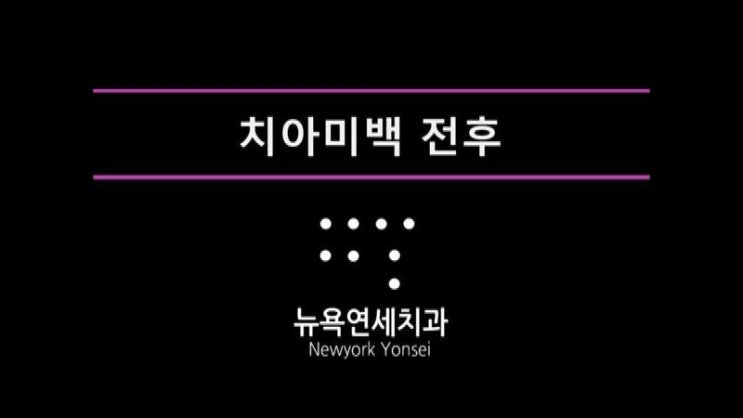  치아미백 비용＆가격