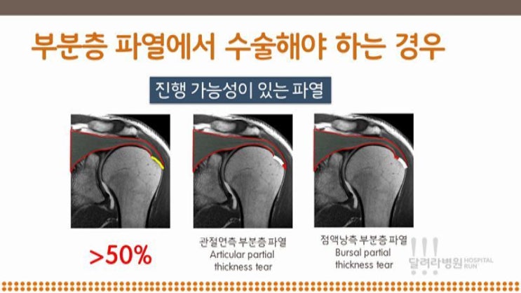 회전근개파열, 부분층파열 : 네이버 블로그