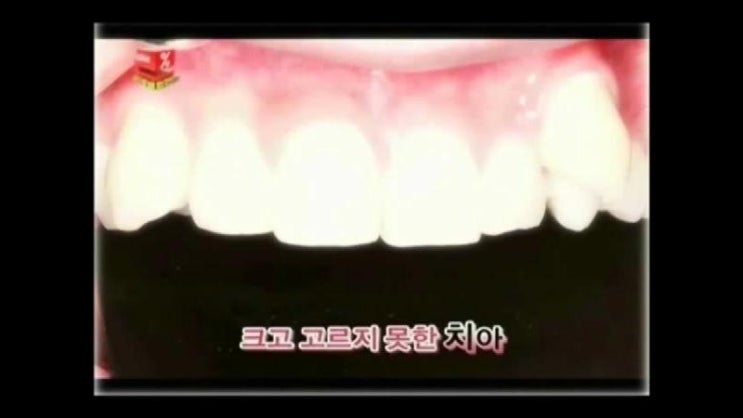  [치아성형 사진] 시크릿 치아성형 전후 사진과 효과