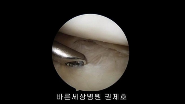  원판형 반월상 연골판 치료, 재활 및 회복 방법 via 양천구 제이본정형외과 권제호