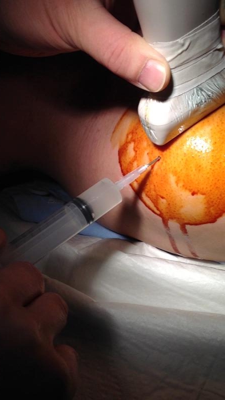 석회성 건염, 석회흡입추사 치료