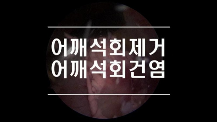  어깨석회제거 관절경을 이용한 어깨석회성건염치료 (Calcific Tendinitis)