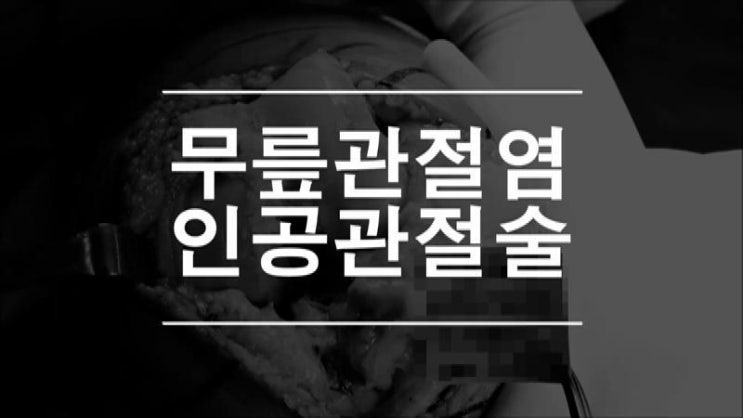  무릎인공관절 양쪽 무릎관절염을 동시에