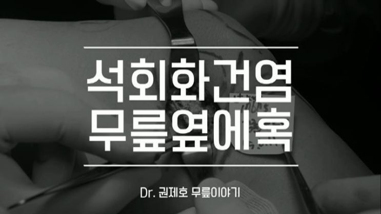  무릎석회 석회제거 하는 방법