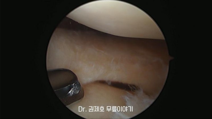  무릎반월상연골판파열 meniscus 무릎통증 잦아진다면