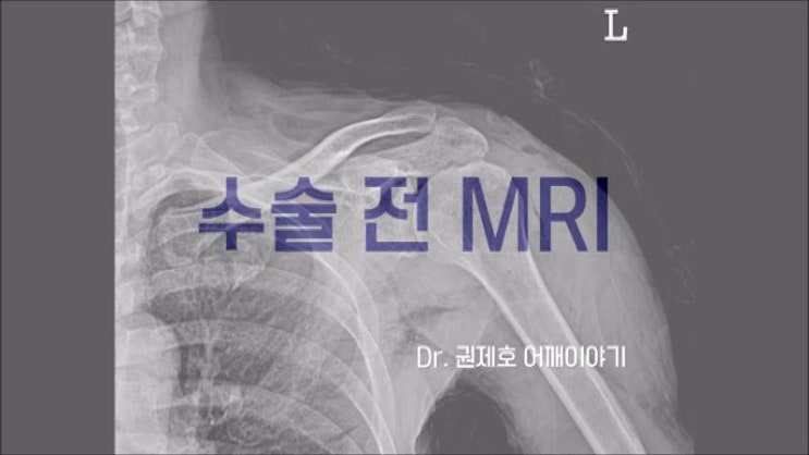  어깨회전근개파열수술 끊어진 인대를 봉합해서