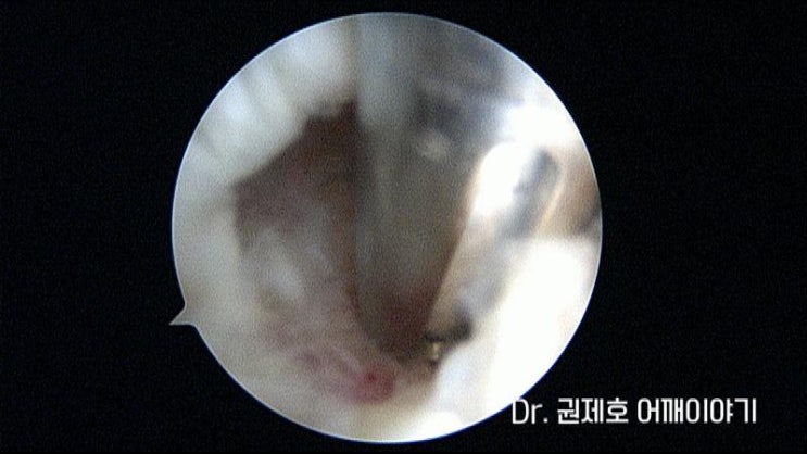  어깨관절내시경 회전근개수술 시 필요한 과정