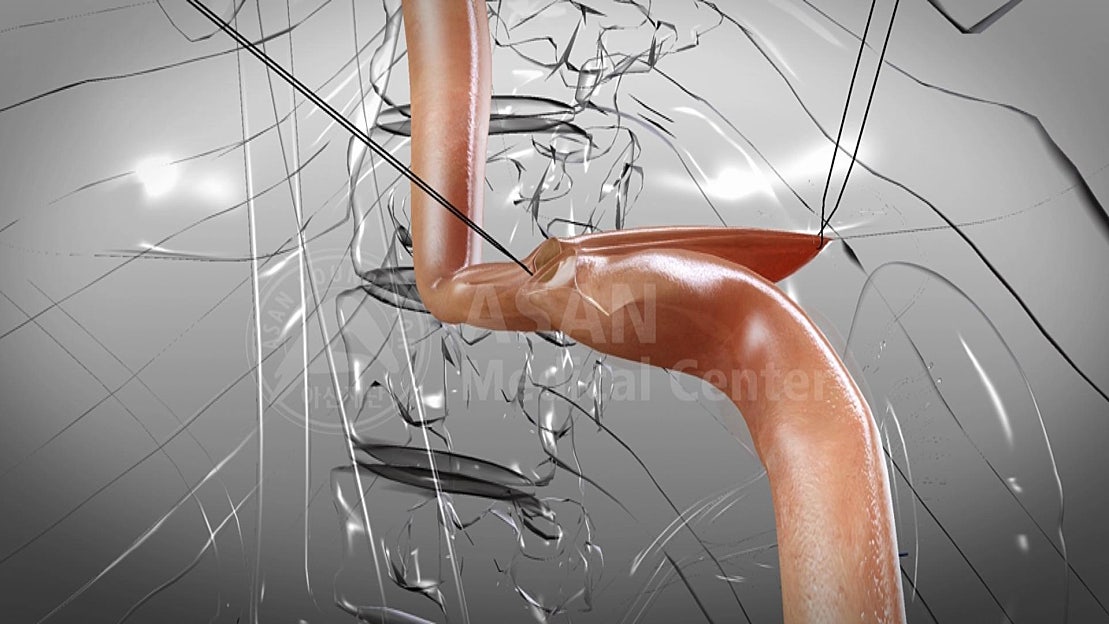 Subtotal Sacrectomy Subtotal Gastrectomy(90%) - 네이버 TV