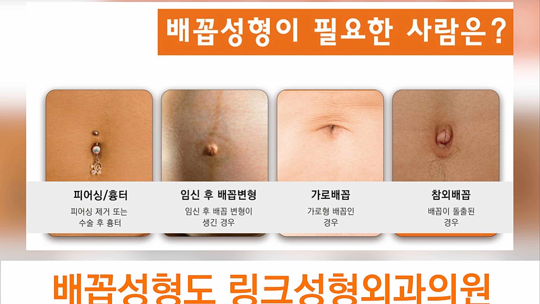 배꼽성형_배꼽수술_링크성형외과_성하민원장_정민수원장 - 네이버 TV