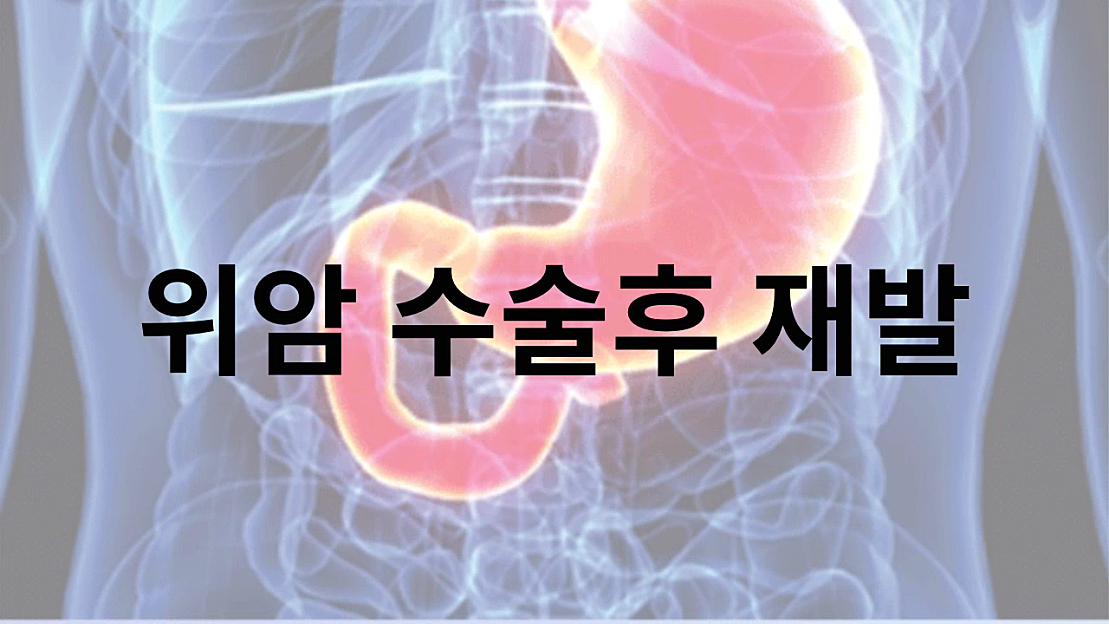 위암 수술후 재발 전이 관리에 좋은음식 알아볼게요 - 네이버 TV