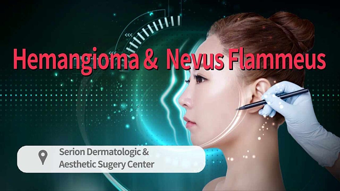 treatment-of-nevus-flammeus-and-hemangioma-with-av-malformation