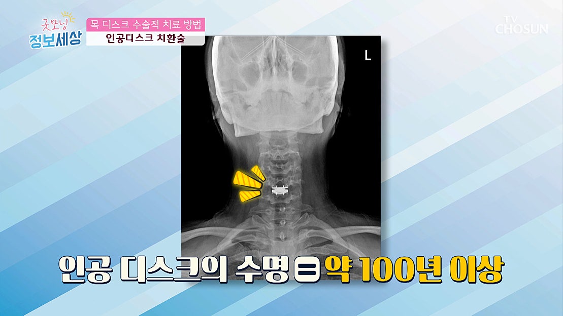 심각한 목 디스크 치료 방법이 수술뿐이라면? TV CHOSUN 230407 방송 - 네이버 TV