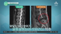 삐끗했나? 젊다고 방심하면 큰일난다! 다른 듯 비슷한 허리디스크와 척추관협착증! #허리통증 #허리질환