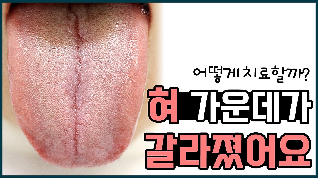 혀 가운데가 갈라졌어요. 혀 갈라짐이 점점 심해져요 - 네이버 TV