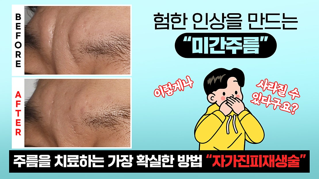 험한 인상을 만드는 '미간주름' 없앨 수 있습니다! (Feat. 자가진피재생술) - 네이버 TV